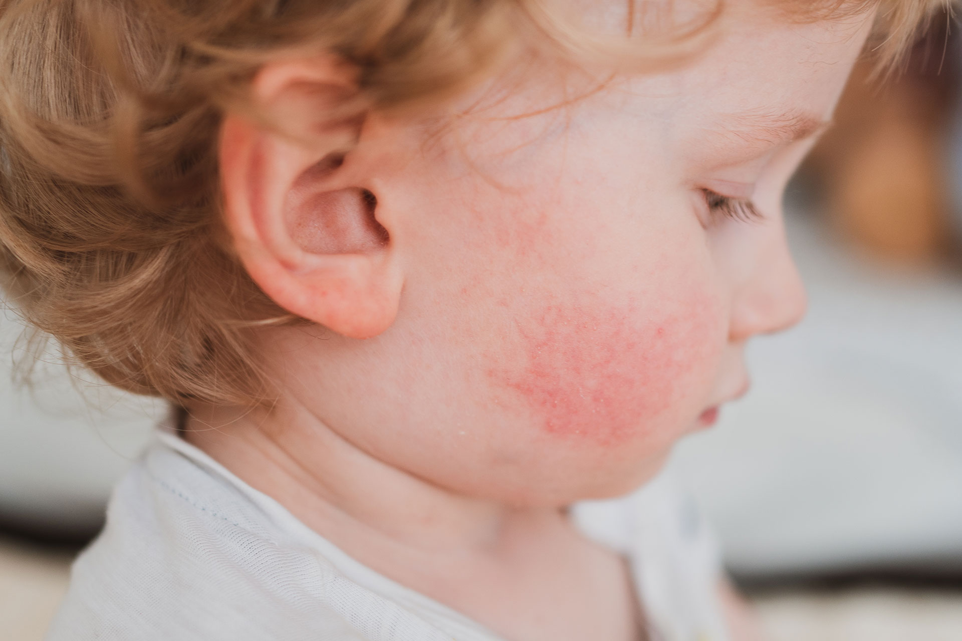 bambino con sintomi di allergia infantile